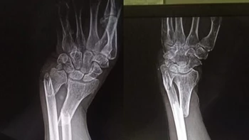 Víctima de brutal agresión, cacique chiquitano pide recursos para nueva operación y justicia para el ataque